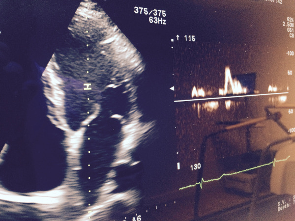 ecocardiografia aviles