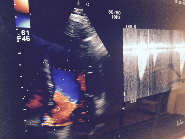 ecocardiografia aviles